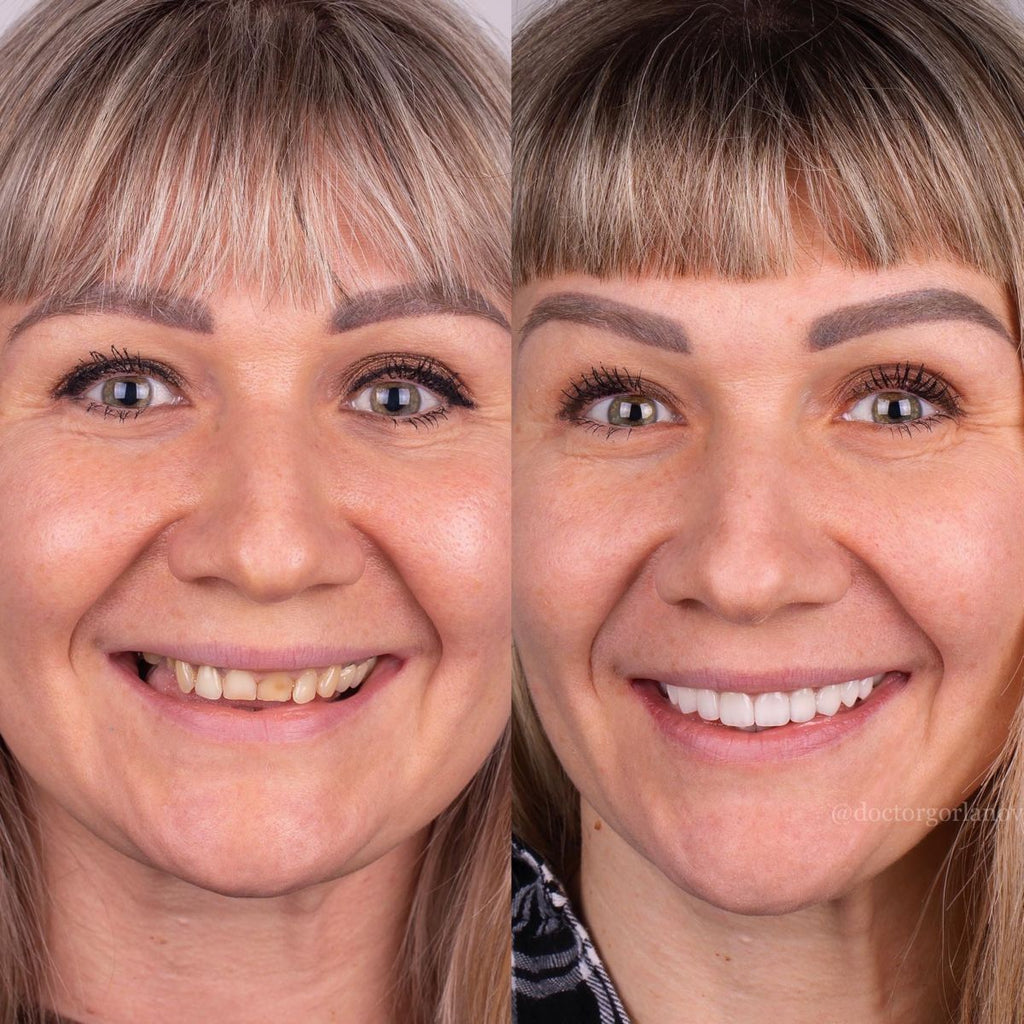 Snap on Smile -الأصلية