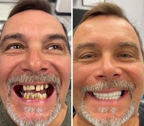 Snap on Smile -الأصلية